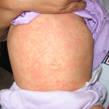 Roseola - KidsHealth